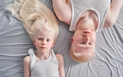 Consecuencias de ser albino