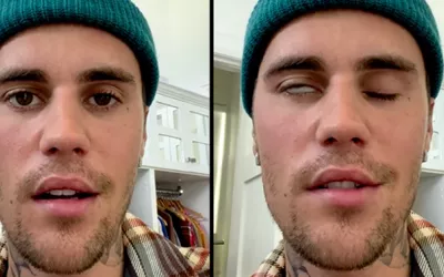 Síndrome Ramsay Hunt Justin Bieber con el síndrome de Ramsay Hunt