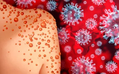 Gripe del tomate, cómo ataca a los niños esta nueva infección Virus de la gripe del tomate