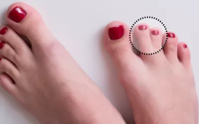 Sindactilia, la malformación que ocultó Almudena Cid Pie con Sindactilia