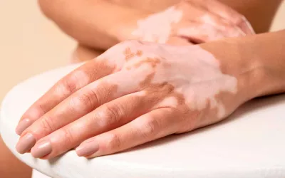 Mujer joven con vitíligo en las manos