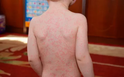 Mononucleosis infecciosa