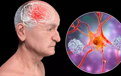Ilustración 3D de una persona de edad avanzada con deterioro cerebral
