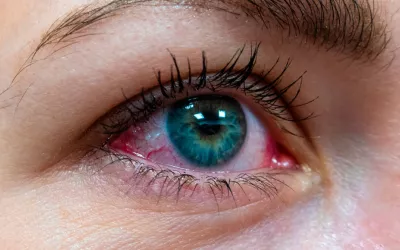 Ojos rojos: causas del enrojecimiento ocular y cómo evitarlo Chica con los ojos rojos