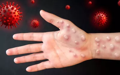 Virus Alaskapox, qué es y cómo se transmite la viruela de Alaska Mano con erupciones provocadas por el virus Alaskapox