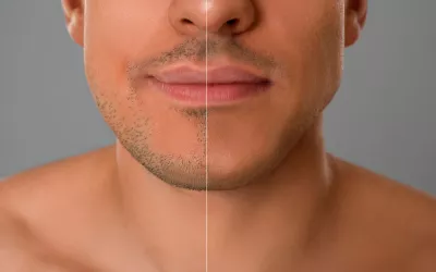 Un rostro con el antes y el después de realizar mewing