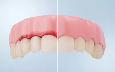 Comparación de encías sanas vs gingivitis en la representación 3D detallada.