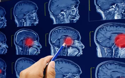 Médico revisa resonancias magnéticas del cerebro y tumores cerebrales