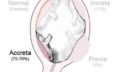Dibujo de placenta accreta