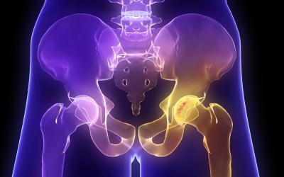 Osteoporosis vista en un radiografía