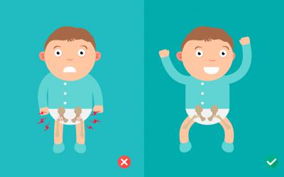 Ilustración que muestra el efecto de la displasia en bebés