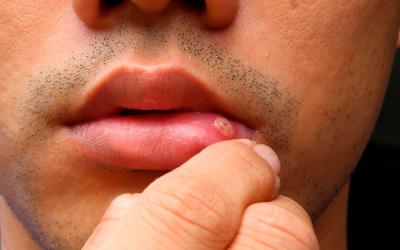 Hombre con una llaga en la boca como consecuencia de la enfermedad de Behçet
