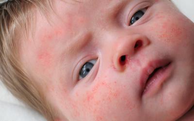 Engordaderas, el acné del recién nacido