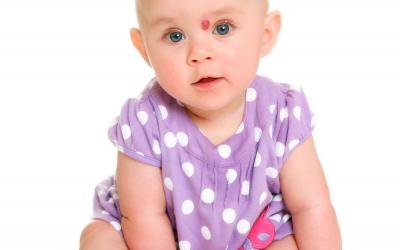 Bebé con un hemangioma sobre la nariz