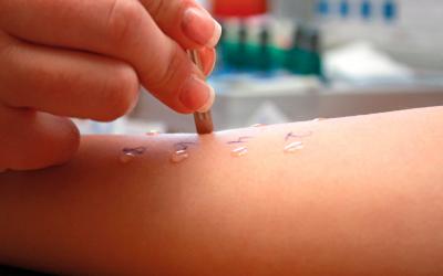 Prick test: pruebas cutáneas de alergia