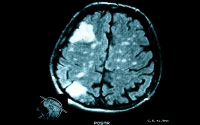 Qué son los tumores cerebrales