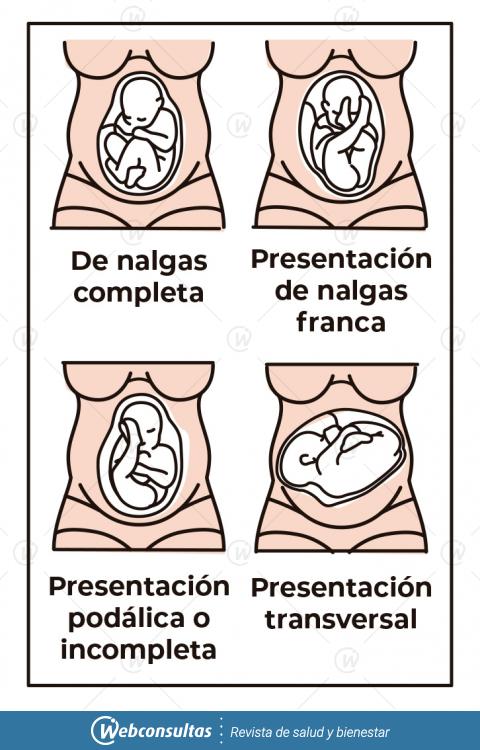 Posiciones del feto en un parto de nalgas