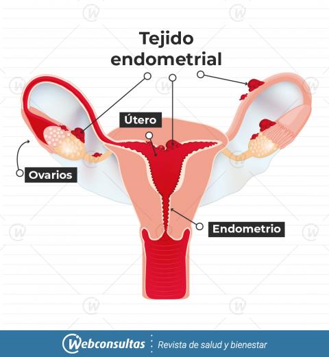 Infografía endometriosis