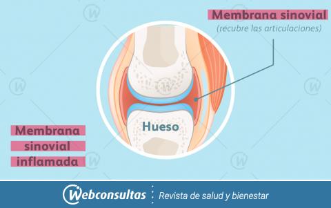 Ilustración membrana sinovial