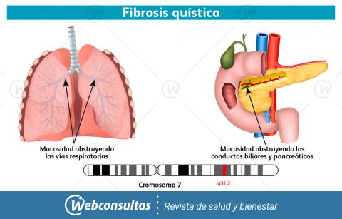 Infografía de la fibrosis quística