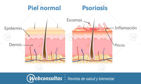 Infografía: piel normal vs psoriasis