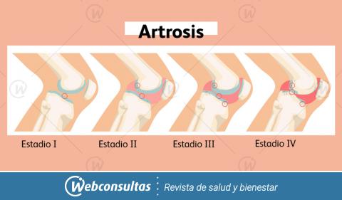 Artrosis, estadios