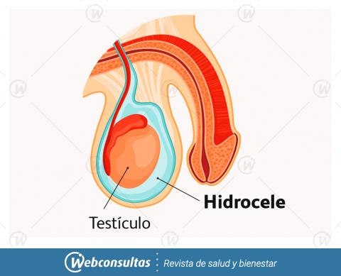 Infografía: hidrocele
