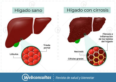 Ilustración hígado con cirrosis e hígado sano