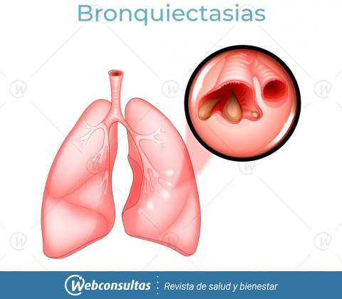 Bronquiectasias: ilustración