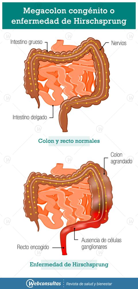 Infografía megacolon congénito