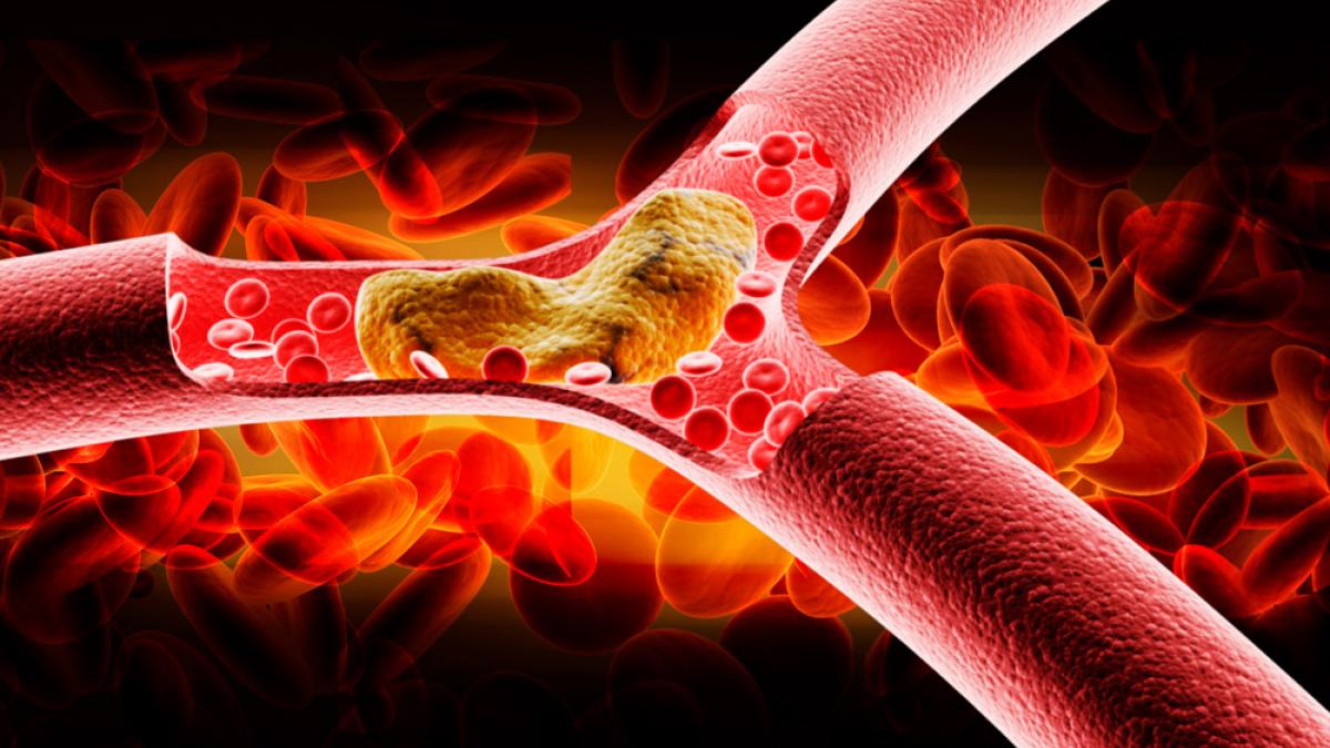 Arteriosclerosis, qué es y qué consecuencias tiene - Salud al día