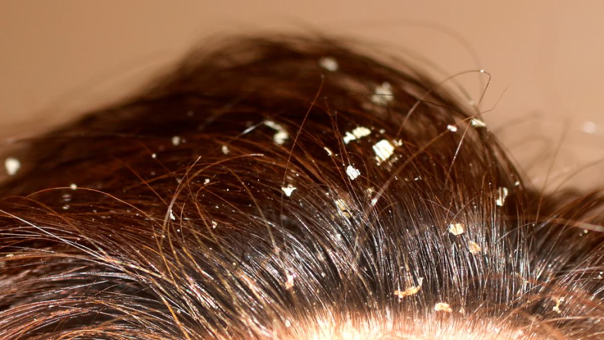 marca mantener barrera Descamación del cuero cabelludo, qué es y posibles causas
