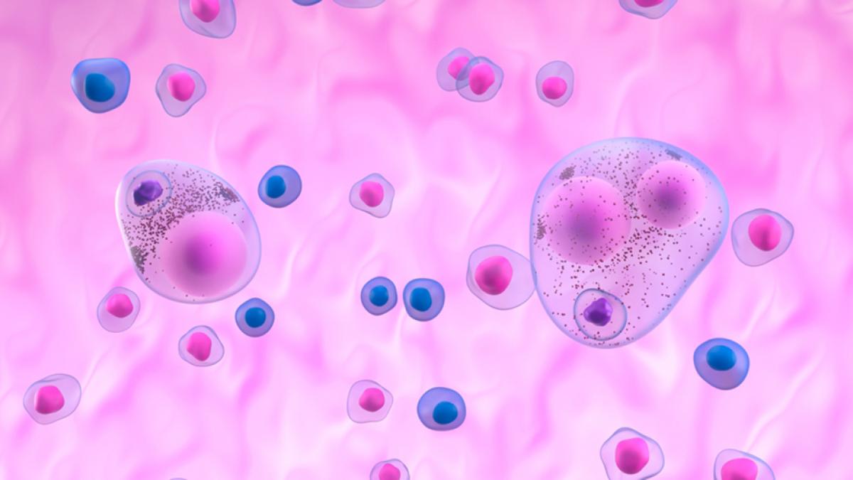 Prueba detecta la enfermedad de cuerpos de Lewy antes de que dé síntomas