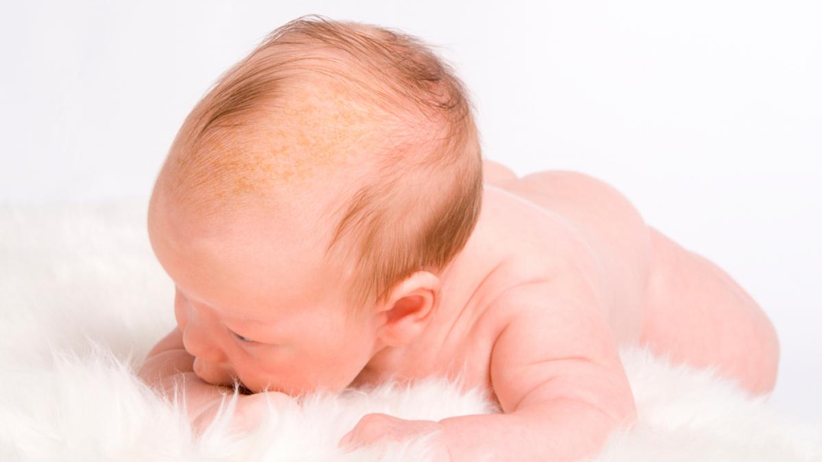 Costra láctea, cómo tratar la dermatitis seborreica del bebé