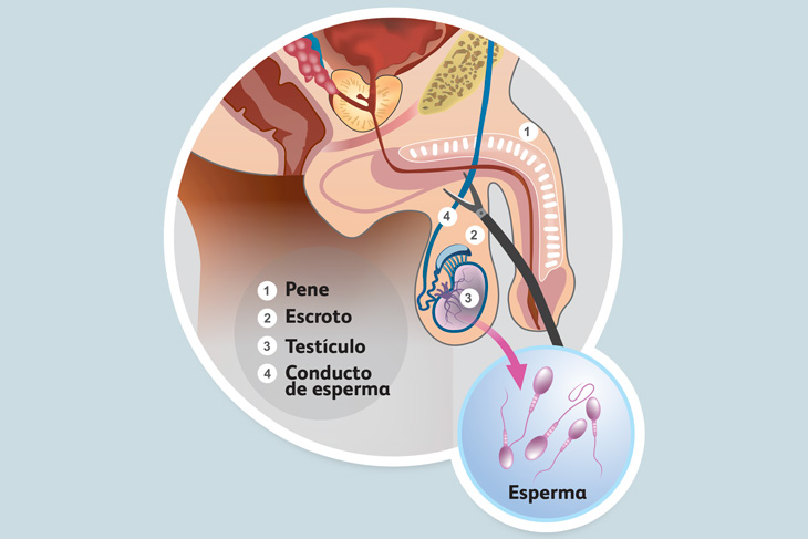 vasectomie procedure